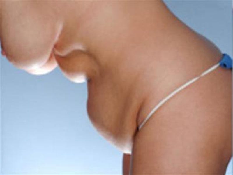Tummy Tuck Before & After Gallery - Patient 138718 - Image 3
