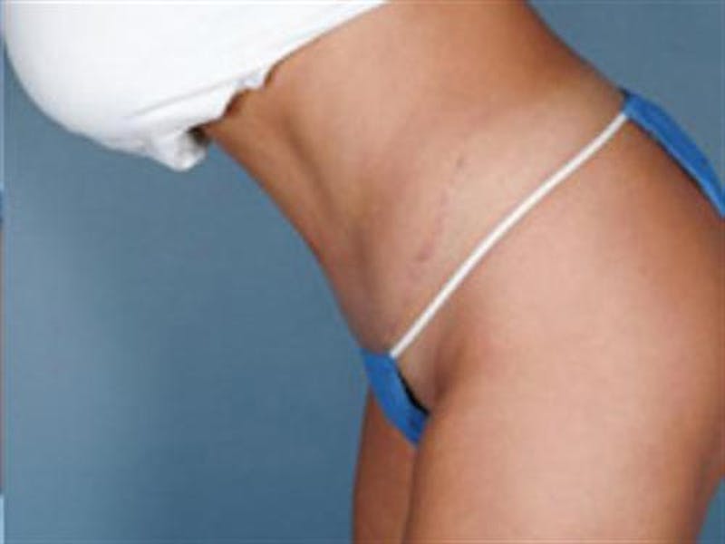Tummy Tuck Before & After Gallery - Patient 138718 - Image 4