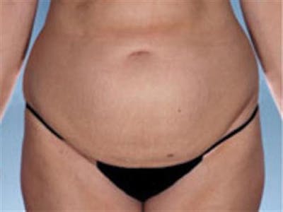 Tummy Tuck Before & After Gallery - Patient 388188 - Image 1