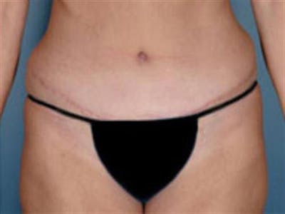 Tummy Tuck Before & After Gallery - Patient 388188 - Image 2