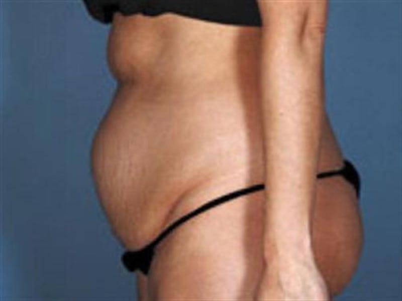 Tummy Tuck Before & After Gallery - Patient 388188 - Image 3