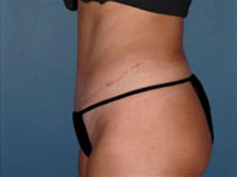Tummy Tuck Before & After Gallery - Patient 388188 - Image 4