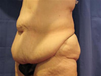 Tummy Tuck Before & After Gallery - Patient 131016 - Image 1