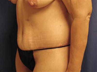 Tummy Tuck Before & After Gallery - Patient 131016 - Image 2