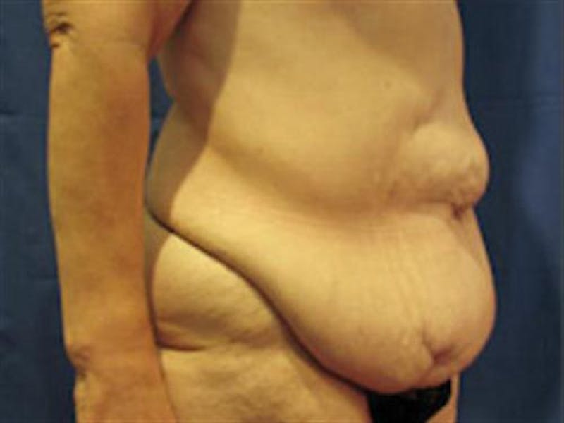 Tummy Tuck Before & After Gallery - Patient 131016 - Image 3