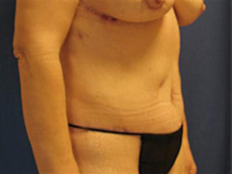 Tummy Tuck Before & After Gallery - Patient 131016 - Image 4