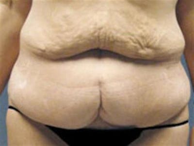 Tummy Tuck Before & After Gallery - Patient 347474 - Image 1