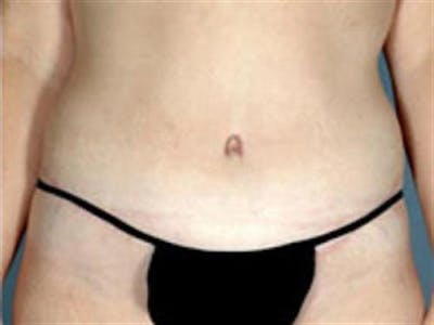 Tummy Tuck Before & After Gallery - Patient 347474 - Image 2