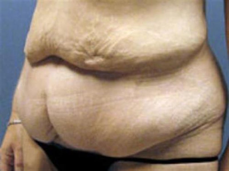 Tummy Tuck Before & After Gallery - Patient 347474 - Image 3