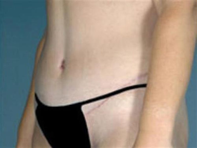 Tummy Tuck Before & After Gallery - Patient 347474 - Image 4