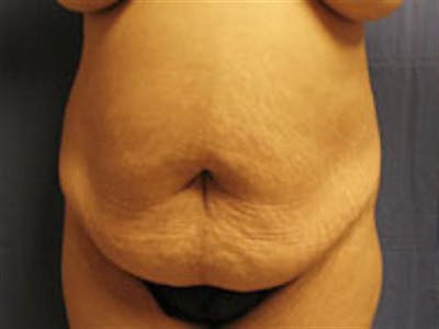Tummy Tuck Before & After Gallery - Patient 116933 - Image 1