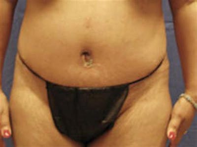 Tummy Tuck Before & After Gallery - Patient 116933 - Image 2