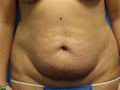 Tummy Tuck Before & After Gallery - Patient 851815 - Image 1