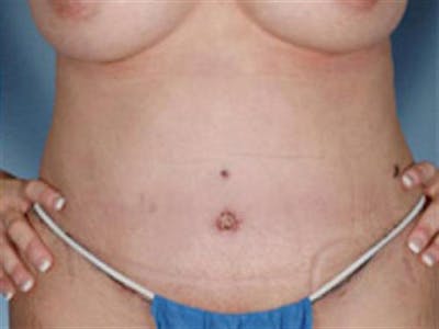 Tummy Tuck Before & After Gallery - Patient 851815 - Image 2