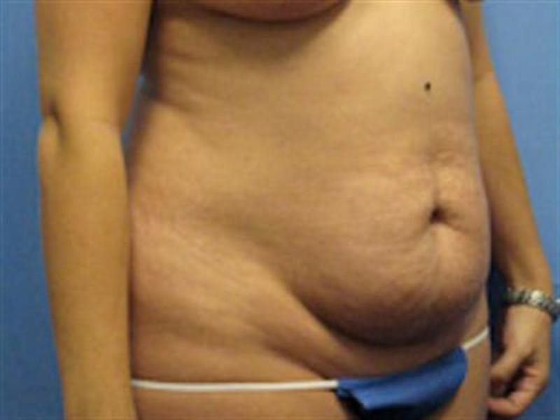 Tummy Tuck Before & After Gallery - Patient 851815 - Image 3