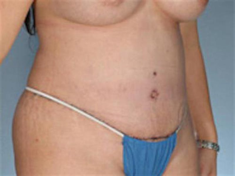 Tummy Tuck Before & After Gallery - Patient 851815 - Image 4