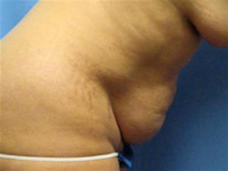 Tummy Tuck Before & After Gallery - Patient 851815 - Image 5