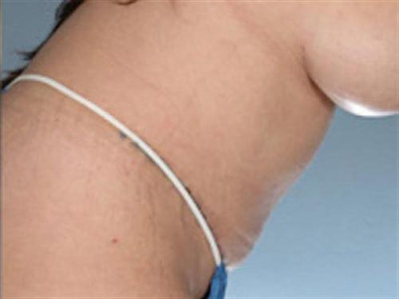 Tummy Tuck Before & After Gallery - Patient 851815 - Image 6