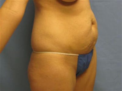 Tummy Tuck Before & After Gallery - Patient 393683 - Image 1
