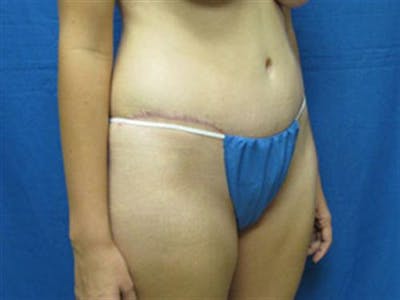 Tummy Tuck Before & After Gallery - Patient 393683 - Image 2