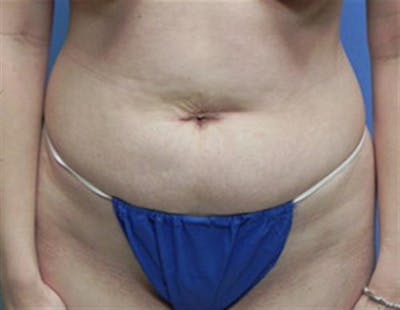 Tummy Tuck Before & After Gallery - Patient 318750 - Image 1