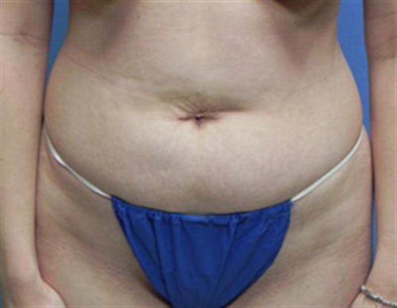 Tummy Tuck Before & After Gallery - Patient 318750 - Image 1