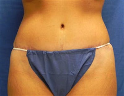 Tummy Tuck Before & After Gallery - Patient 318750 - Image 2