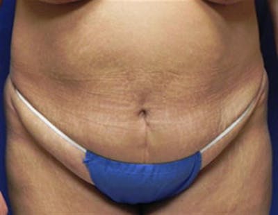 Tummy Tuck Before & After Gallery - Patient 260325 - Image 1