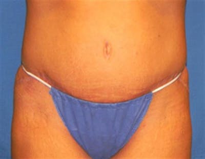 Tummy Tuck Before & After Gallery - Patient 260325 - Image 2