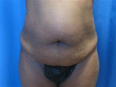 Tummy Tuck Before & After Gallery - Patient 370592 - Image 1