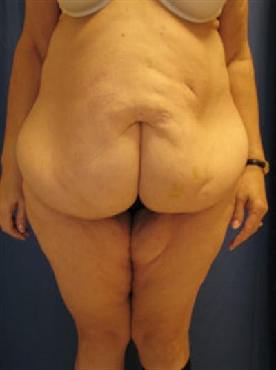 Tummy Tuck Before & After Gallery - Patient 331506 - Image 1