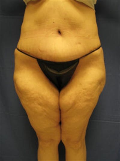 Tummy Tuck Before & After Gallery - Patient 331506 - Image 2