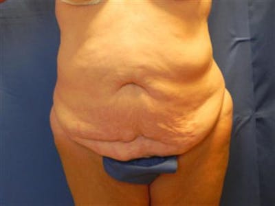 Tummy Tuck Before & After Gallery - Patient 338983 - Image 1