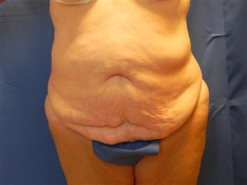 Tummy Tuck Before & After Gallery - Patient 338983 - Image 1