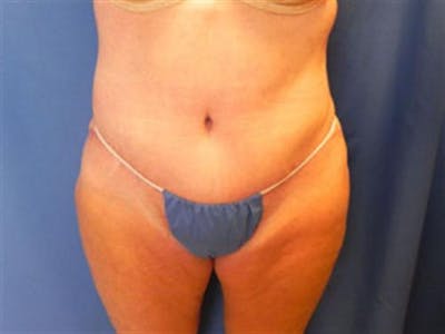 Tummy Tuck Before & After Gallery - Patient 338983 - Image 2