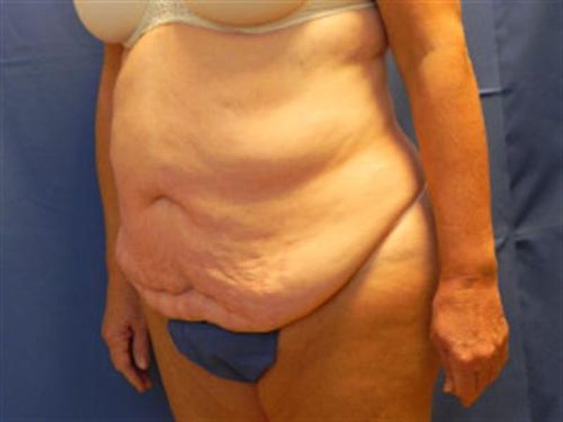 Tummy Tuck Before & After Gallery - Patient 338983 - Image 3