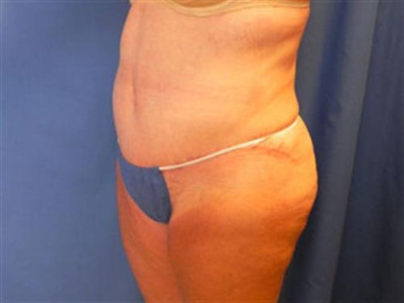 Tummy Tuck Before & After Gallery - Patient 338983 - Image 4
