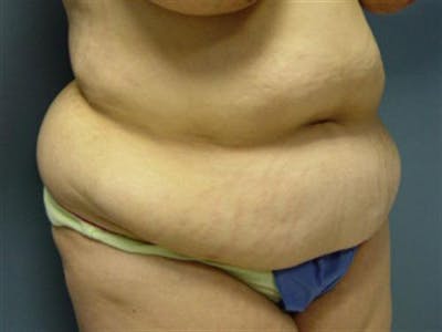 Tummy Tuck Before & After Gallery - Patient 271236 - Image 1