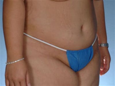 Tummy Tuck Before & After Gallery - Patient 271236 - Image 2