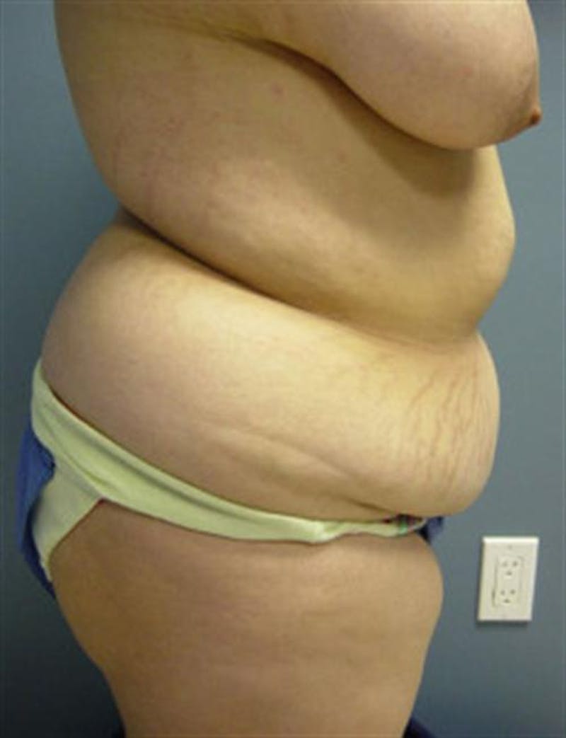 Tummy Tuck Before & After Gallery - Patient 271236 - Image 3