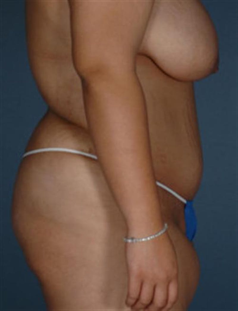 Tummy Tuck Before & After Gallery - Patient 271236 - Image 4