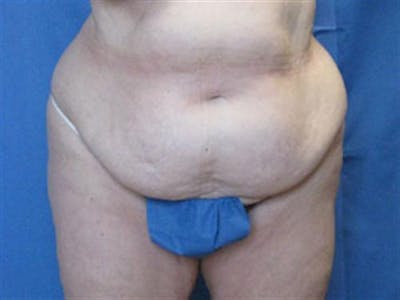 Tummy Tuck Before & After Gallery - Patient 134103 - Image 1