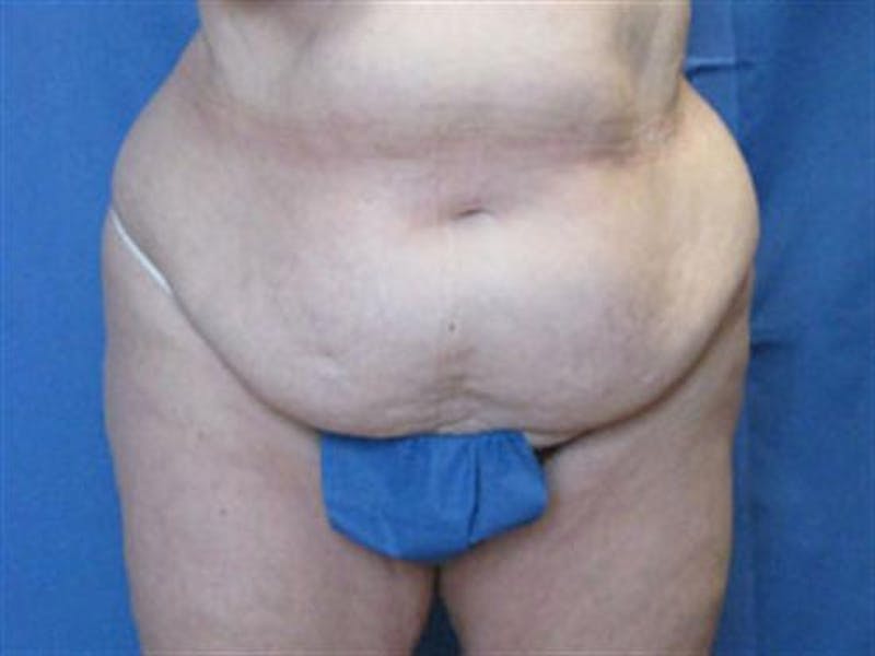 Tummy Tuck Before & After Gallery - Patient 134103 - Image 1