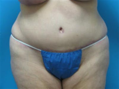 Tummy Tuck Before & After Gallery - Patient 134103 - Image 2