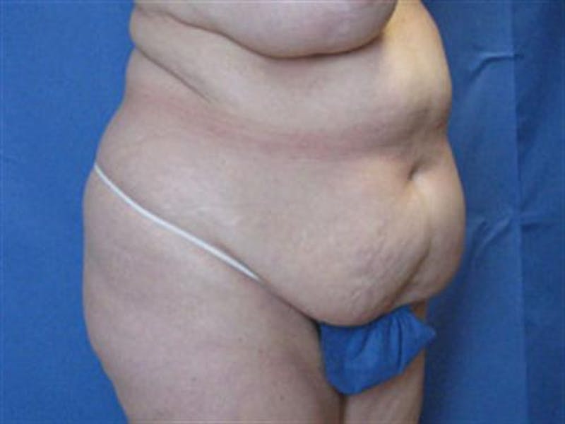 Tummy Tuck Before & After Gallery - Patient 134103 - Image 3