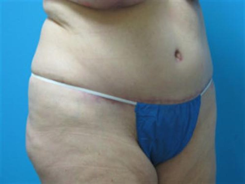 Tummy Tuck Before & After Gallery - Patient 134103 - Image 4