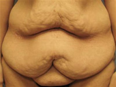 Tummy Tuck Before & After Gallery - Patient 114531 - Image 1