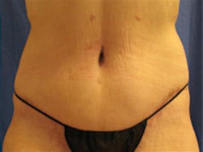 Tummy Tuck Before & After Gallery - Patient 114531 - Image 2