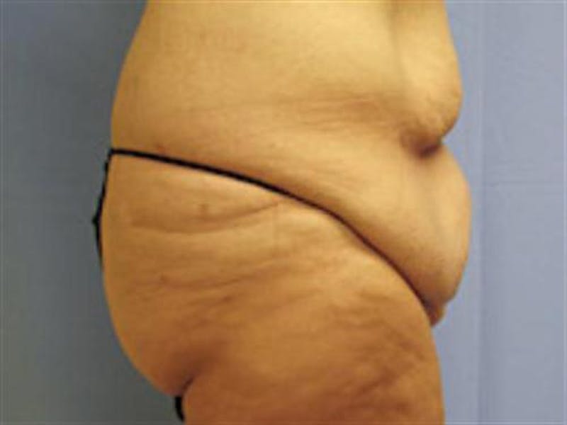 Tummy Tuck Before & After Gallery - Patient 114531 - Image 3