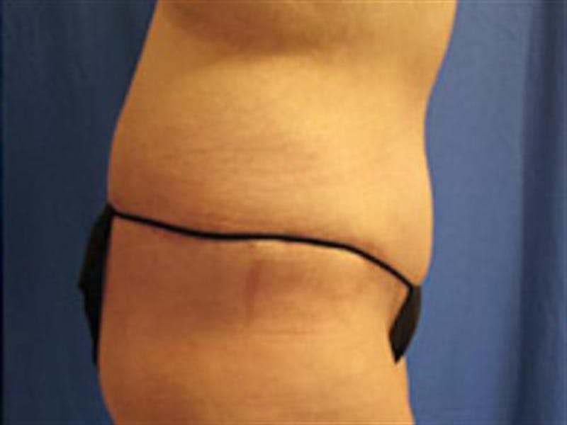 Tummy Tuck Before & After Gallery - Patient 114531 - Image 4